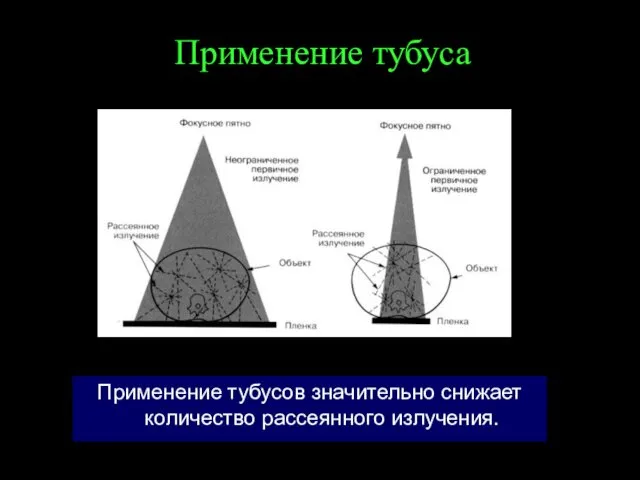 Применение тубуса Применение тубусов значительно снижает количество рассеянного излучения.