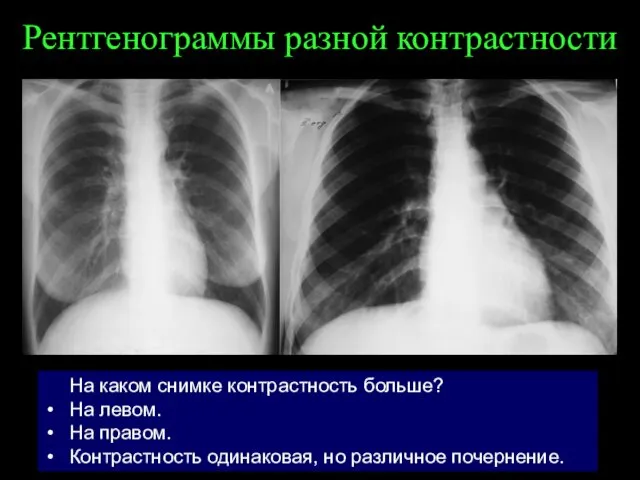 Рентгенограммы разной контрастности На каком снимке контрастность больше? На левом. На правом. Контрастность
