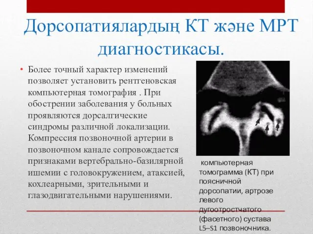 Дорсопатиялардың КТ және МРТ диагностикасы. Более точный характер изменений позволяет