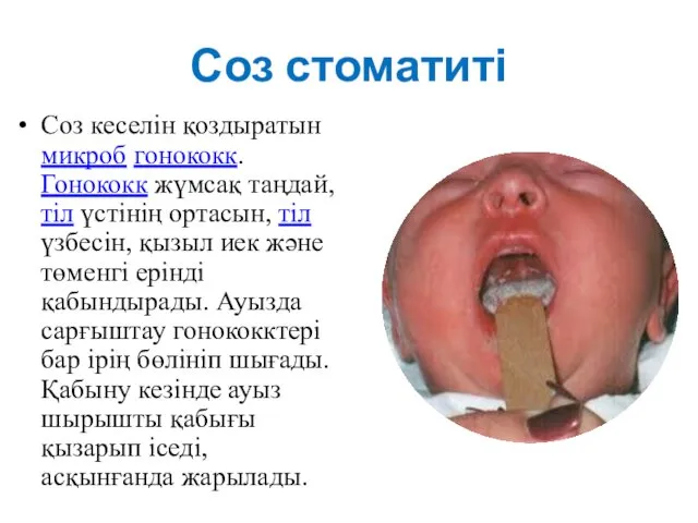 Соз стоматиті Соз кеселін қоздыратын микроб гонококк. Гонококк жүмсақ таңдай,