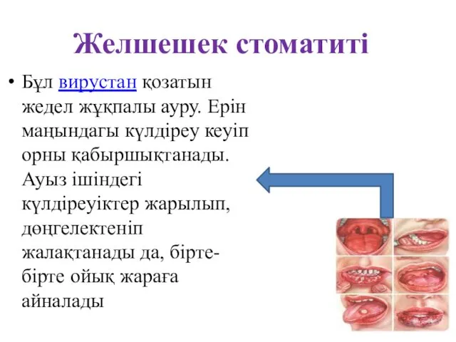 Желшешек стоматиті Бұл вирустан қозатын жедел жұқпалы ауру. Ерін маңындагы