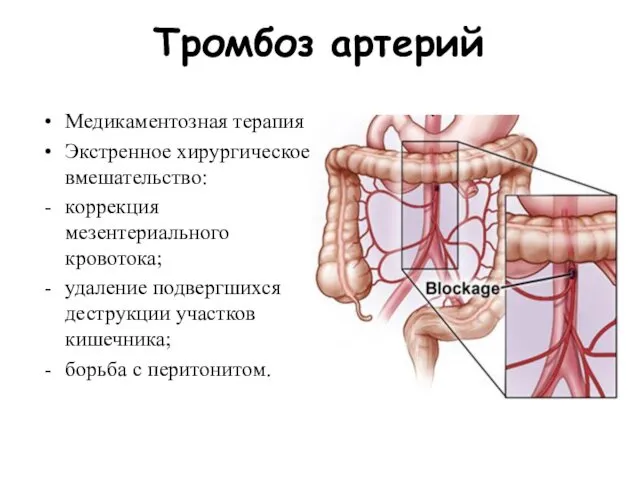 Тромбоз артерий Медикаментозная терапия Экстренное хирургическое вмешательство: коррекция мезентериального кровотока;