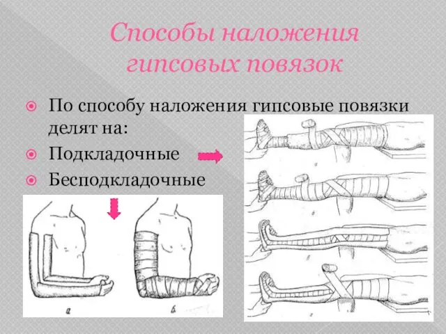 Способы наложения гипсовых повязок По способу наложения гипсовые повязки делят на: Подкладочные Бесподкладочные