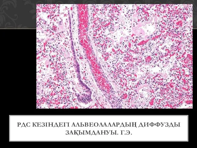 РДС КЕЗІНДЕГІ АЛЬВЕОЛАЛАРДЫҢ ДИФФУЗДЫ ЗАҚЫМДАНУЫ. Г.Э.