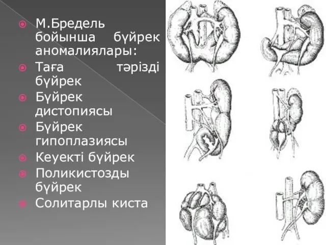 М.Бредель бойынша бүйрек аномалиялары: Таға тәрізді бүйрек Бүйрек дистопиясы Бүйрек