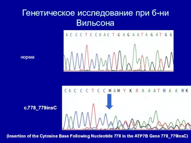 Генетическое исследование при б-ни Вильсона норма c.778_779insC (Insertion of the