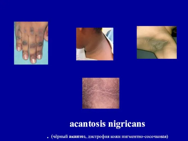 acantosis nigricans . (чёрный акантоз, дистрофия кожи пигментно-сосочковая)