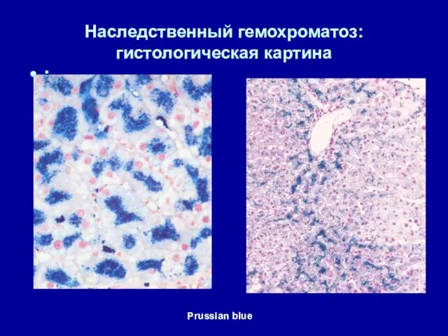 Наследственный гемохроматоз: гистологическая картина : Prussian blue