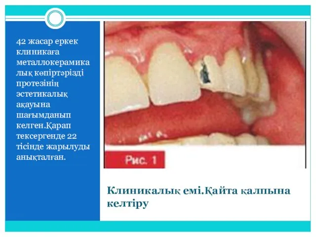 Клиникалық емі.Қайта қалпына келтіру 42 жасар еркек клиникаға металлокерамикалық көпіртәрізді