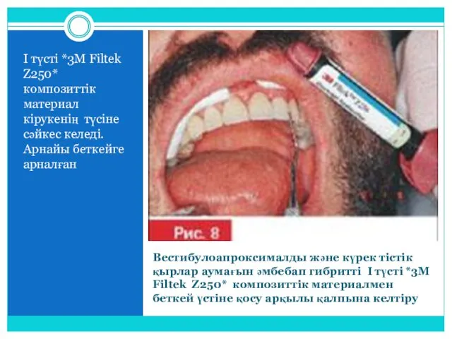 Вестибулоапроксималды және күрек тістік қырлар аумағын әмбебап гибритті I түсті