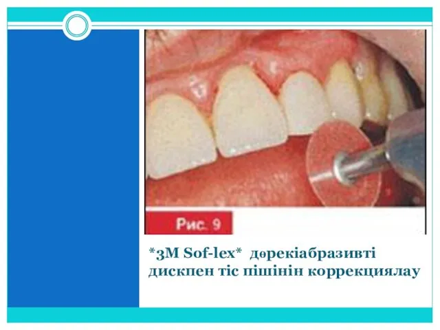 *3M Sof-lex* дөрекіабразивті дискпен тіс пішінін коррекциялау
