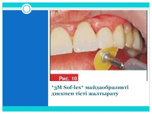 *3M Sof-lex* майдаобразивті дискпен тісті жалтырату