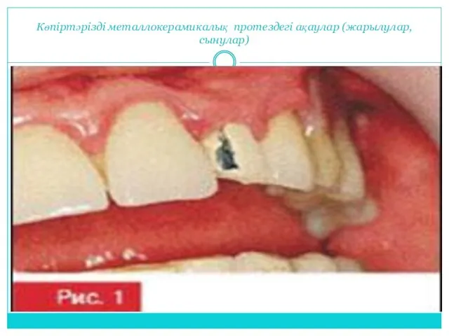 Көпіртәрізді металлокерамикалық протездегі ақаулар (жарылулар,сынулар)