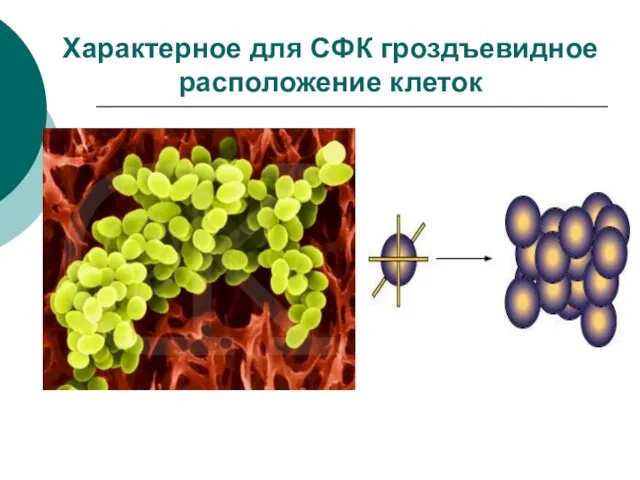 Характерное для СФК гроздъевидное расположение клеток