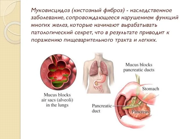 Муковисцидоз (кистозный фиброз) - наследственное заболевание, сопровождающееся нарушением функций многих желез, которые начинают