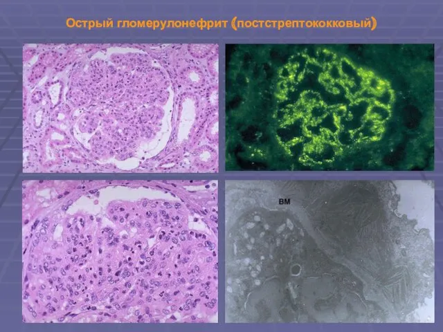 Острый гломерулонефрит (постстрептококковый)