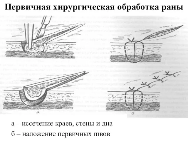 Первичная хирургическая обработка раны а – иссечение краев, стены и дна б – наложение первичных швов