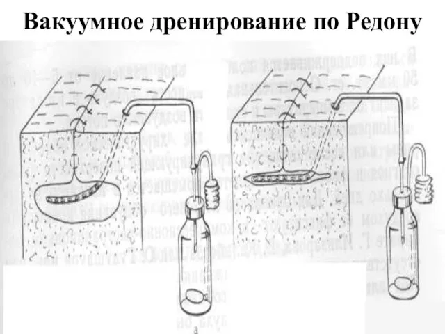 Вакуумное дренирование по Редону