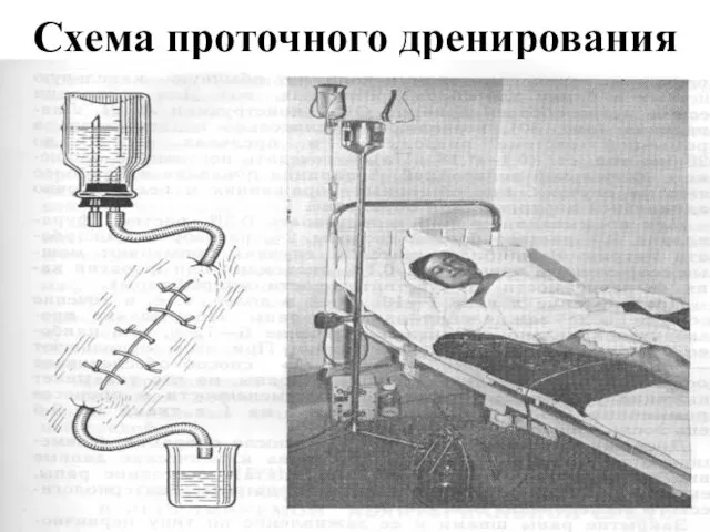 Схема проточного дренирования