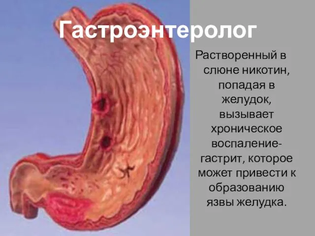 Гастроэнтеролог Растворенный в слюне никотин, попадая в желудок, вызывает хроническое