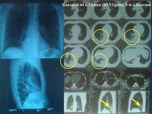 Больной 44 г. Грипп (H1N1)pdm, 5-й д.болезни