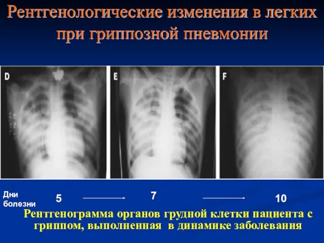 Рентгенологические изменения в легких при гриппозной пневмонии Рентгенограмма органов грудной