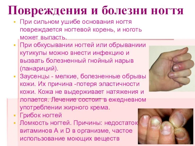 Повреждения и болезни ногтя При сильном ушибе основания ногтя повреждается ногтевой корень, и