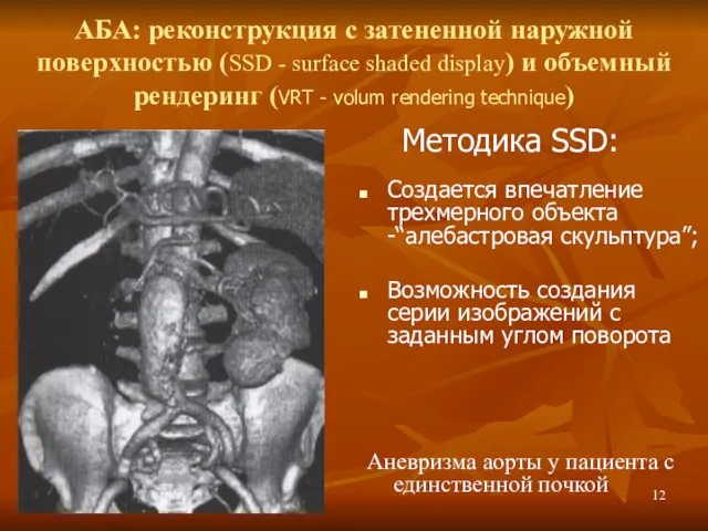 АБА: реконструкция с затененной наружной поверхностью (SSD - surface shaded