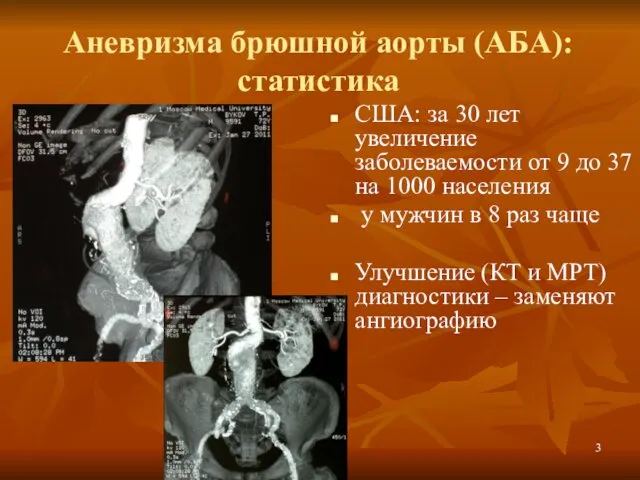 Аневризма брюшной аорты (АБА): статистика США: за 30 лет увеличение