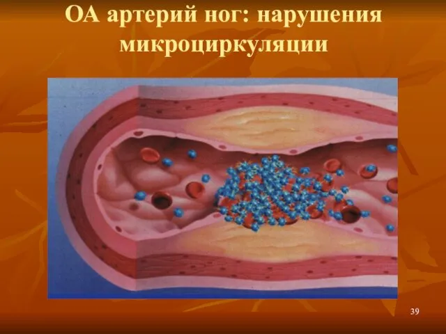 ОА артерий ног: нарушения микроциркуляции
