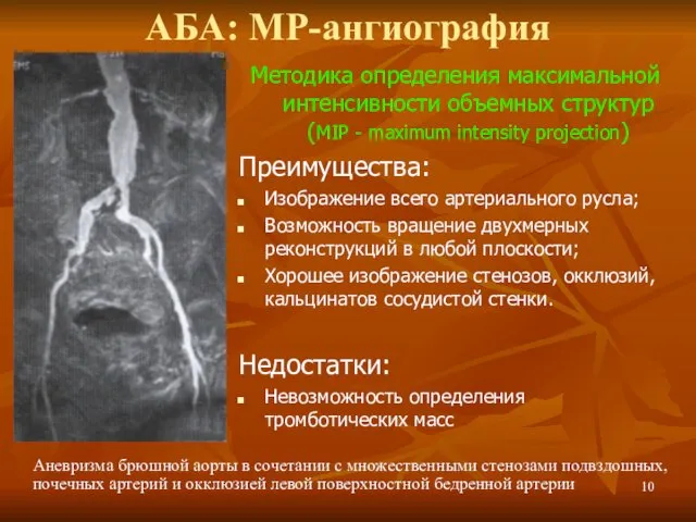 АБА: МР-ангиография Аневризма брюшной аорты в сочетании с множественными стенозами
