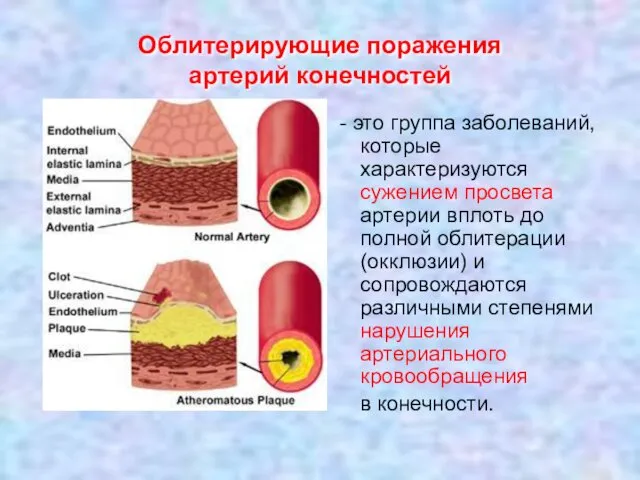 Облитерирующие поражения артерий конечностей - это группа заболеваний, которые характеризуются