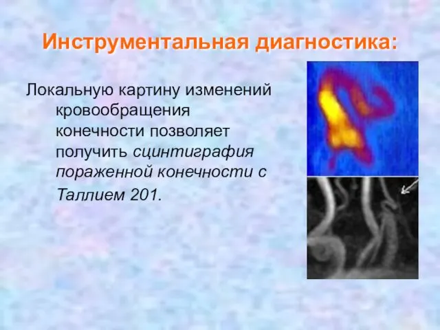 Инструментальная диагностика: Локальную картину изменений кровообращения конечности позволяет получить сцинтиграфия пораженной конечности с Таллием 201.