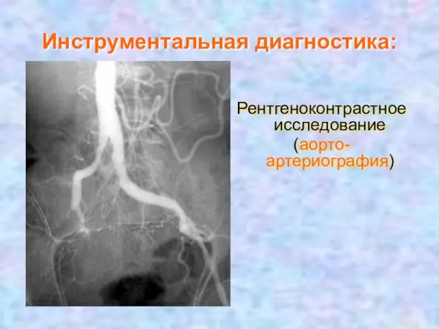 Инструментальная диагностика: Рентгеноконтрастное исследование (аорто-артериография)