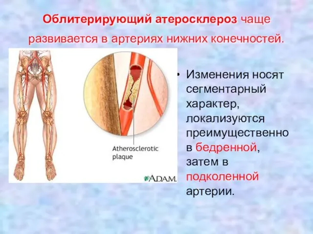 Облитерирующий атеросклероз чаще развивается в артериях нижних конечностей. Изменения носят