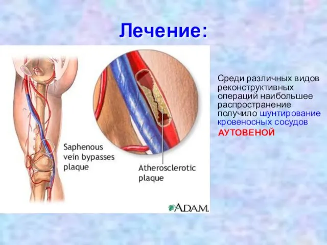 Лечение: Среди различных видов реконструктивных операций наибольшее распространение получило шунтирование кровеносных сосудов АУТОВЕНОЙ