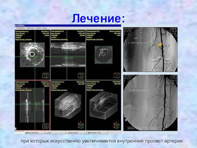 Лечение: при которых искусственно увеличивается внутренний просвет артерии.