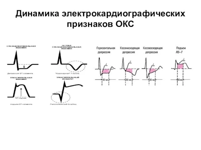 Динамика электрокардиографических признаков ОКС