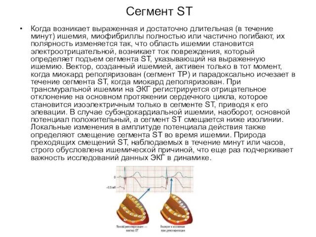 Сегмент ST Когда возникает выраженная и достаточно длительная (в течение