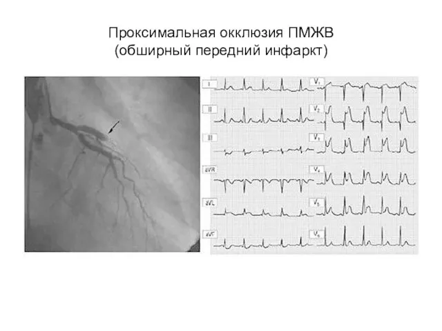 Проксимальная окклюзия ПМЖВ (обширный передний инфаркт)
