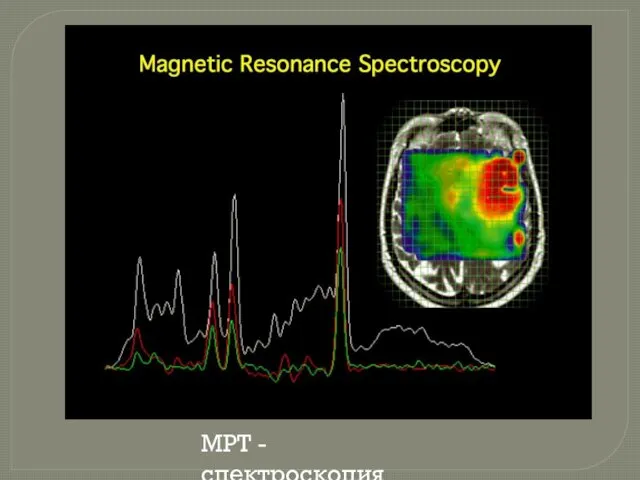 МРТ - спектроскопия
