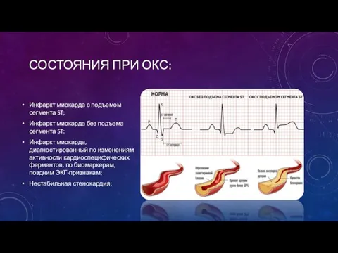 СОСТОЯНИЯ ПРИ ОКС: Инфаркт миокарда с подъемом сегмента ST; Инфаркт миокарда без подъема