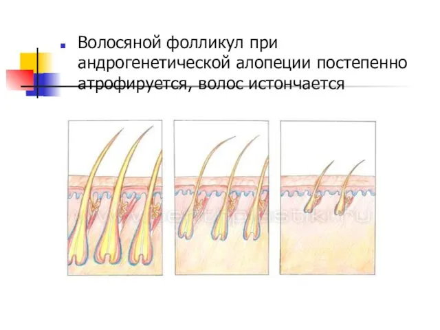Волосяной фолликул при андрогенетической алопеции постепенно атрофируется, волос истончается