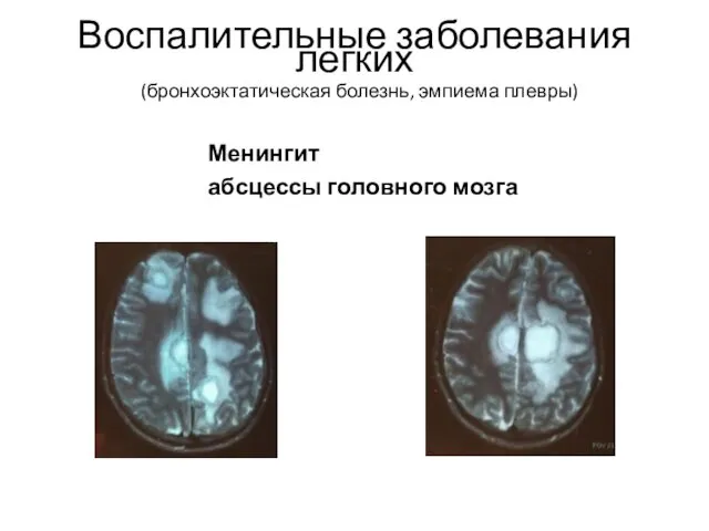 Воспалительные заболевания легких (бронхоэктатическая болезнь, эмпиема плевры) Менингит абсцессы головного мозга