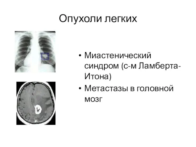 Опухоли легких Миастенический синдром (с-м Ламберта-Итона) Метастазы в головной мозг