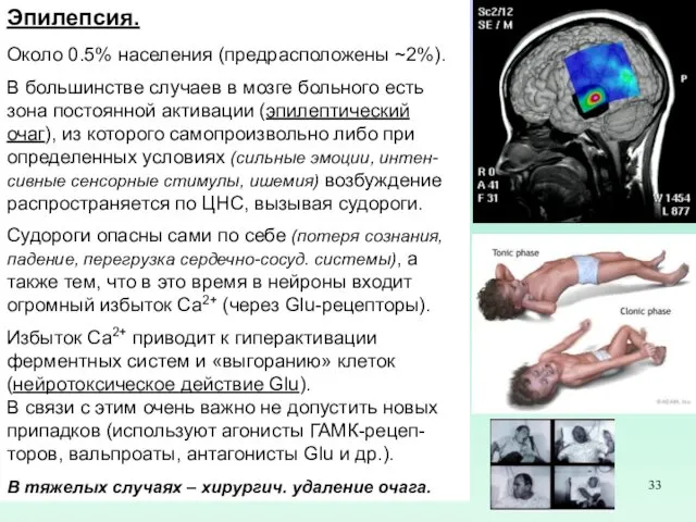 Эпилепсия. Около 0.5% населения (предрасположены ~2%). В большинстве случаев в