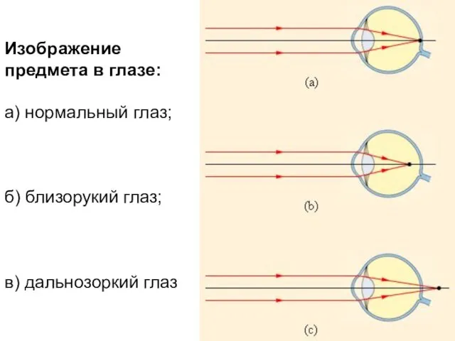 Изображение предмета в глазе: а) нормальный глаз; б) близорукий глаз; в) дальнозоркий глаз