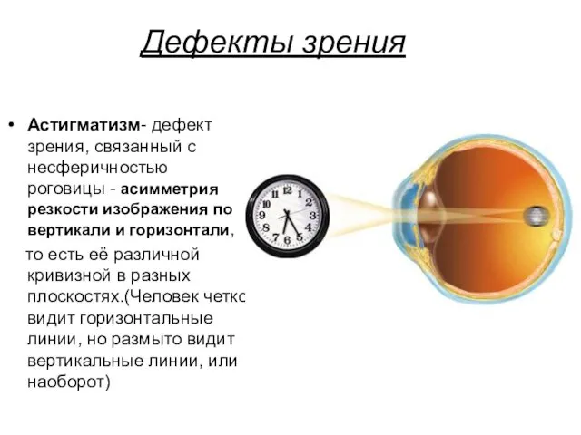 Дефекты зрения Астигматизм- дефект зрения, связанный с несферичностью роговицы -