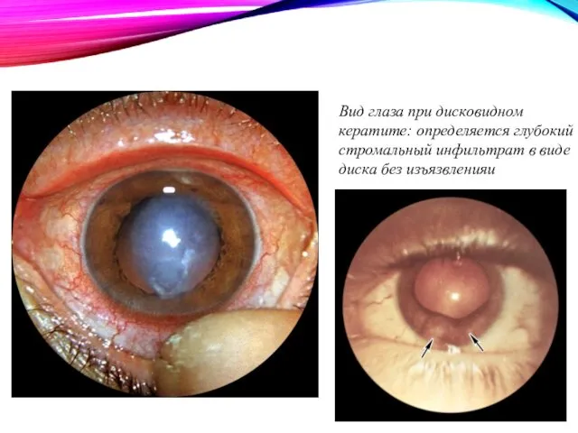 Вид глаза при дисковидном кератите: определяется глубокий стромальный инфильтрат в виде диска без изъязвленияu