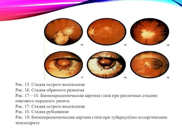 Рис. 15. Стадия острого воспаления Рис. 16. Стадия обратного развития Рис. 17—18. Биомикроскопическая